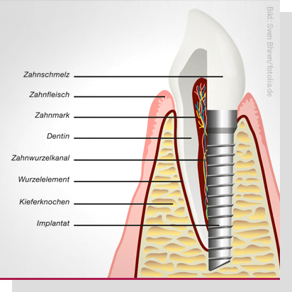 Zahnimplantat als Zahnersatz